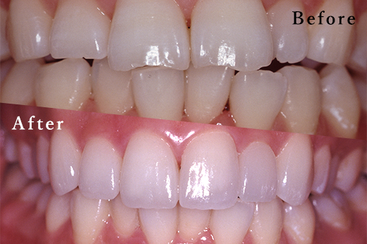 審美歯科【クラウン】