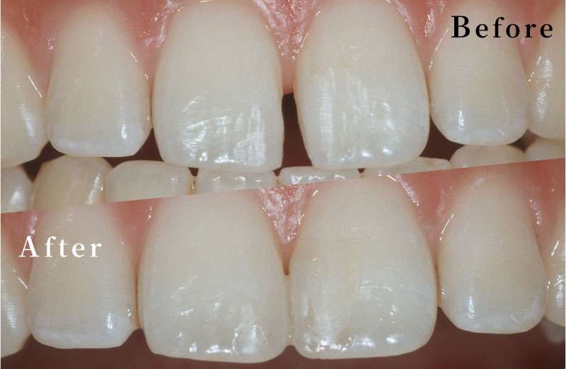 審美歯科【ダイレクトボンディング】