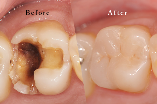 審美歯科【インレー】